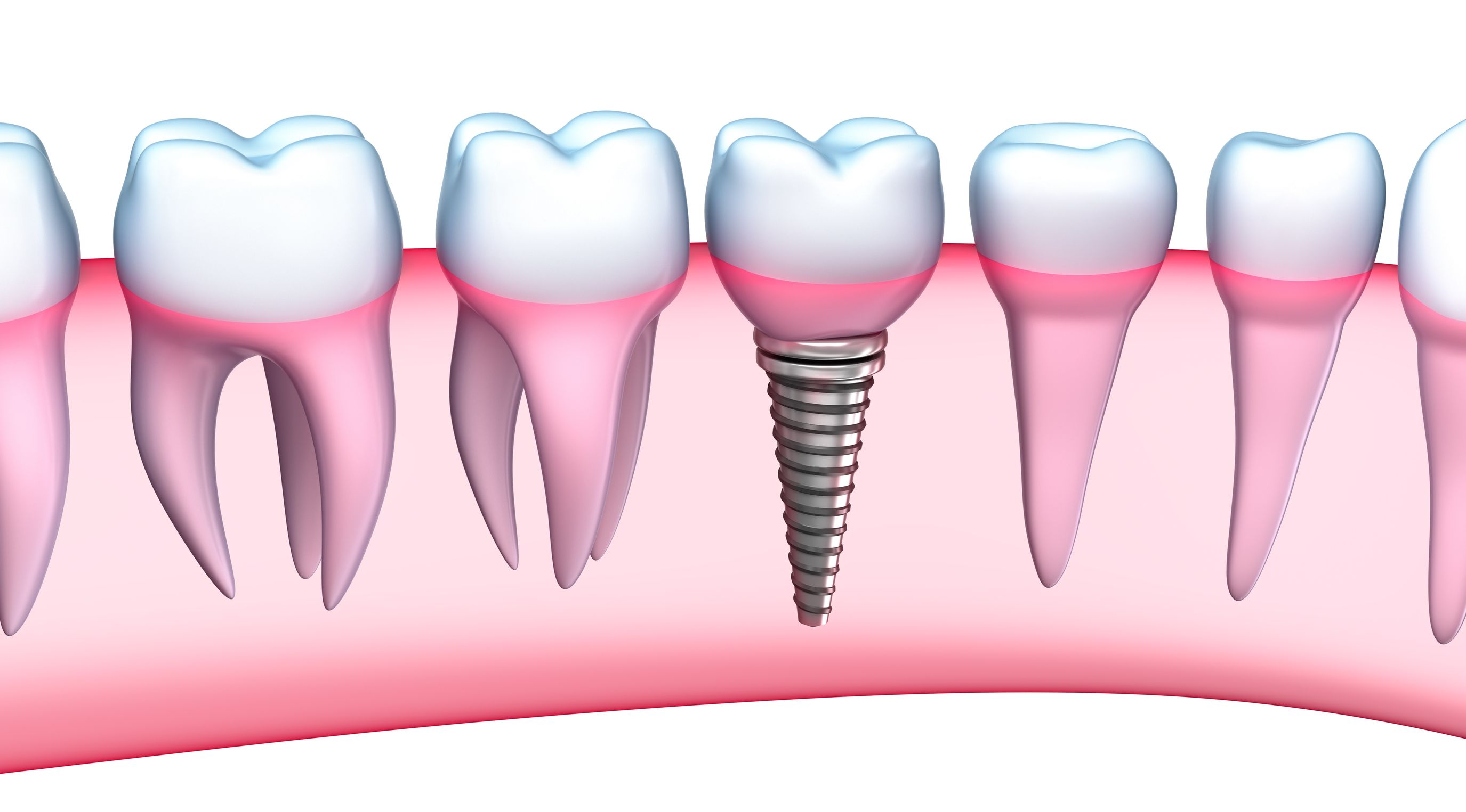 Lo mejor en implantes dentales