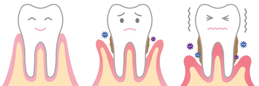 La enfermedad Periodontal. Segunda parte