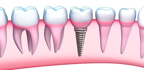 Lo mejor en implantes dentales