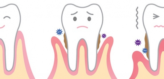 La enfermedad Periodontal. Segunda parte