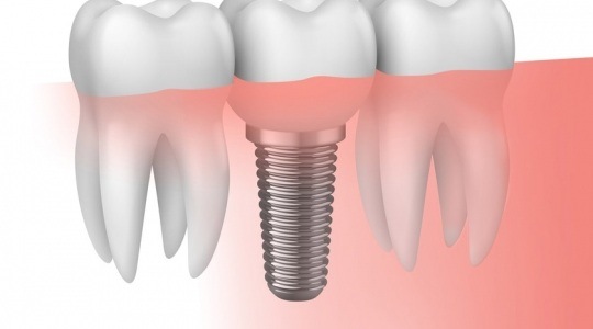 Implantes Dentales